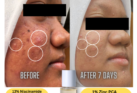 SÁVEE NIACINAMIDE ZINC PCA+ ESSENCE